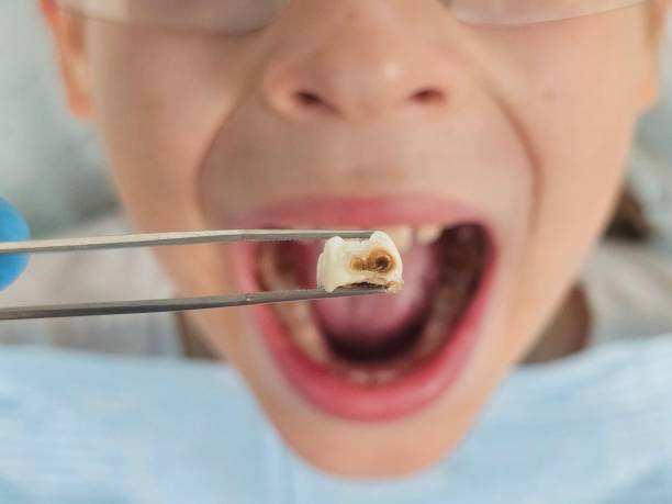 Best Emergency Wisdom Tooth Extraction in Mineralwells, WV